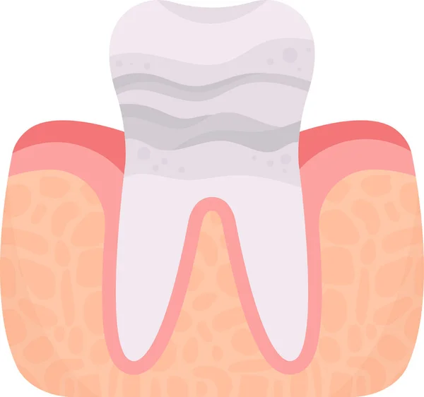 Enamel Erosion Tooth Problem Vector Illustration — Stock Vector