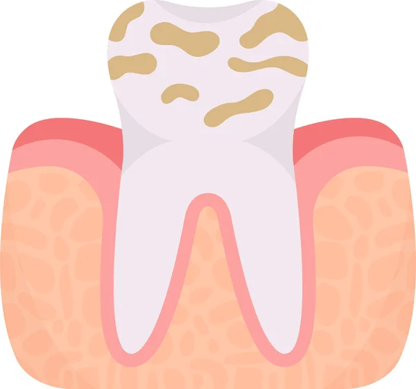 Dental Plaque Tooth Problem Vector Illustration — Stock Vector