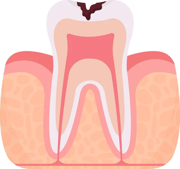 Deep Caries Tooth Problem Vector Illustration — Stock Vector