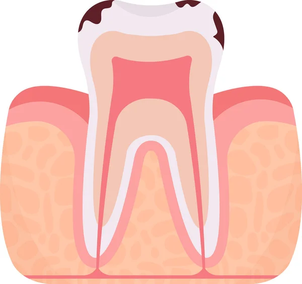 Caries Tooth Problem Vector Illustration — Stock Vector
