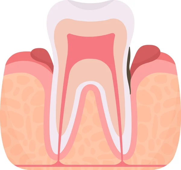 Parodontite Problema Dentale Illustrazione Vettoriale — Vettoriale Stock
