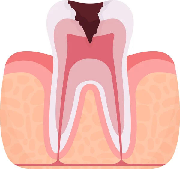 Ilustração Vetor Problema Dente Pulpite — Vetor de Stock