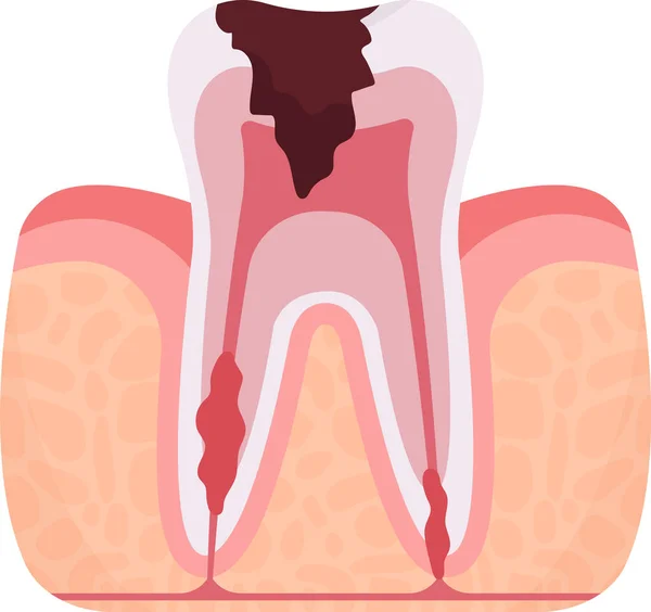 Parodontit Tandproblem Vektor Illustration — Stock vektor