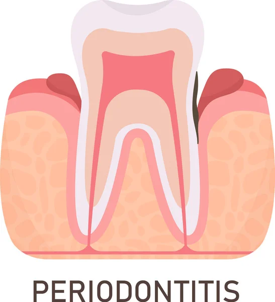 Periodontitis Tooth Problem Vector Illustration — Stock Vector