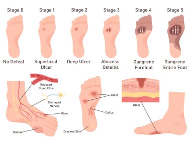 Diabetic foot diseases symptoms stage medical infographic poster. Vector illustration of human leg with no defeat, inflammation, ulcer, skin sore with abcess, gangrene. Healthcare and medicien concept clipart