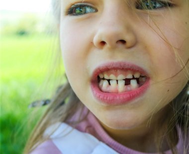 Sevimli bir kızın gülümsemesi. Üç diş döküldü, azı dişleri için çok az yer var. Süt dişleri dökülüyor. Yakın plan. Bir ortodontist tarafından muayene. Yüksek kalite fotoğraf