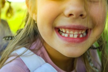 Sevimli bir kızın gülümsemesi. Üç diş döküldü, azı dişleri için çok az yer var. Süt dişleri dökülüyor. Yakın plan. Bir ortodontist tarafından muayene. Yüksek kalite fotoğraf