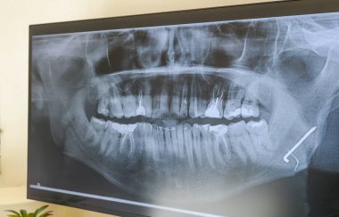 Metal bir plaka ve bir dişinde çivi olan bir adamın röntgeni. Yüksek kalite fotoğraf