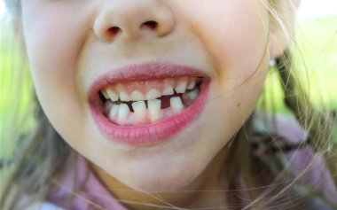 Sevimli bir kızın gülümsemesi. Üç diş döküldü, azı dişleri için çok az yer var. Süt dişleri dökülüyor. Yakın plan. Bir ortodontist tarafından muayene. Yüksek kalite fotoğraf