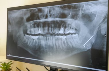 Metal bir plaka ve bir dişinde çivi olan bir adamın röntgeni. Yüksek kalite fotoğraf