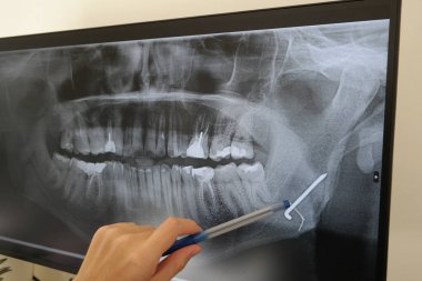 Metal bir plaka ve bir dişinde çivi olan bir adamın röntgeni. Yüksek kalite fotoğraf