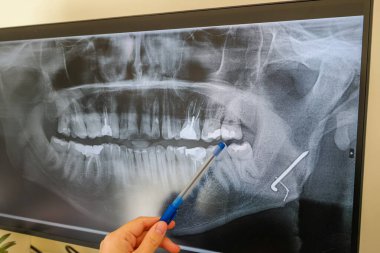 Metal bir plaka ve bir dişinde çivi olan bir adamın röntgeni. Yüksek kalite fotoğraf