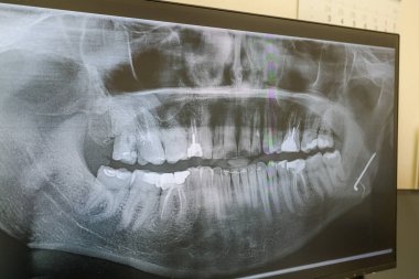 Metal bir plaka ve bir dişinde çivi olan bir adamın röntgeni. Yüksek kalite fotoğraf