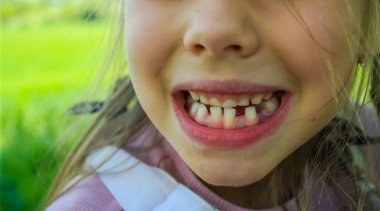 Sevimli bir kızın gülümsemesi. Üç diş döküldü, azı dişleri için çok az yer var. Süt dişleri dökülüyor. Yakın plan. Bir ortodontist tarafından muayene. Yüksek kalite fotoğraf