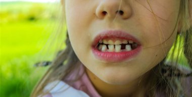 Sevimli bir kızın gülümsemesi. Üç diş döküldü, azı dişleri için çok az yer var. Süt dişleri dökülüyor. Yakın plan. Bir ortodontist tarafından muayene. Yüksek kalite fotoğraf