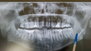 Metal bir plaka ve bir dişinde çivi olan bir adamın röntgeni. Yüksek kalite fotoğraf