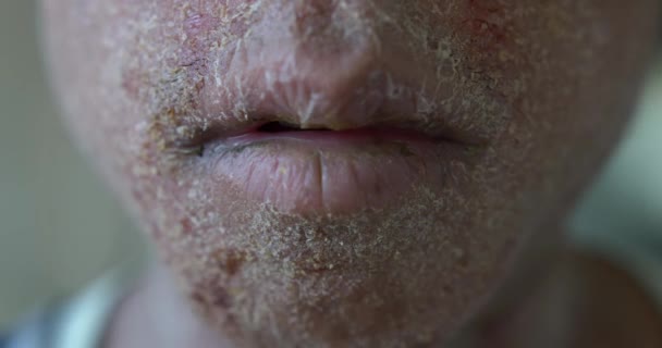 Dry Skin Eczema Patient — Video Stock