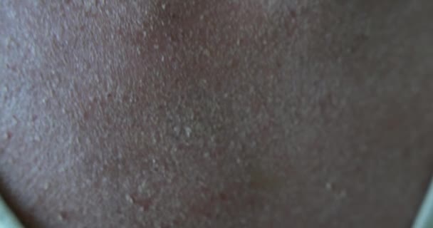 Dry Skin Eczema Patient — Vídeos de Stock