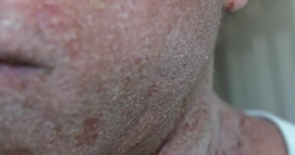 Dry Skin Eczema Patient — Stok video
