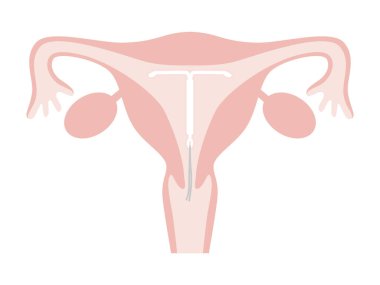 Uterus with intrauterine system (IUS). Simple and flat illustration.
