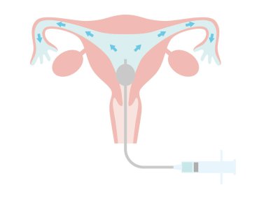 Hysterosalpingography for fertility treatment. A state in which a contrast medium is placed in the uterus. Illustration about pregnancy and childbirth. clipart