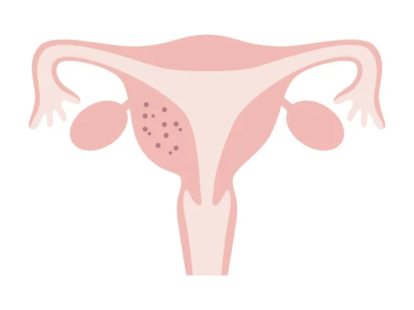 Illustration Adenomyosis Uterus Occurred Part Uterus Diseases Uterus Women — ストックベクタ