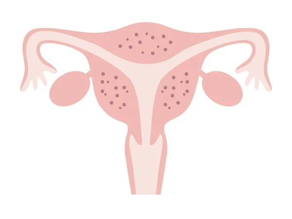 Illustration Adenomyosis Occurs Throughout Uterus Diseases Uterus Women — 스톡 벡터