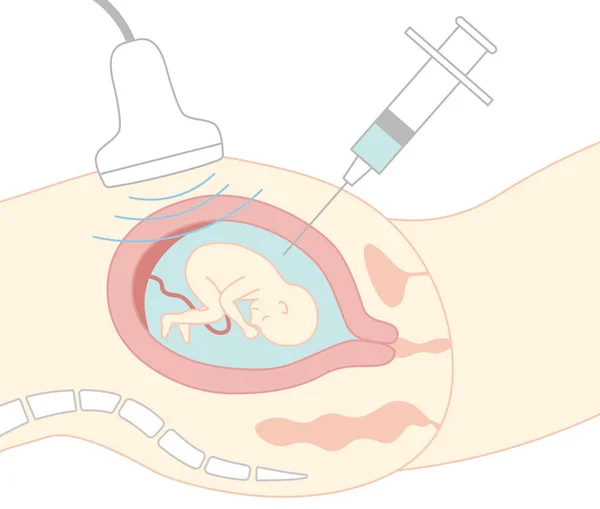 Prenatal Diagnosis Amniocentesis Illustration Pregnant Woman Stomach Seen Side Main — Stok Vektör