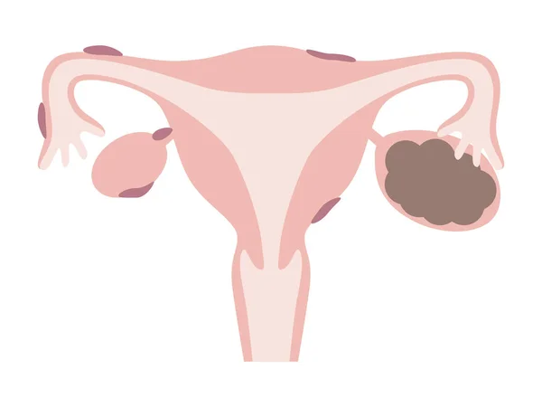 Endometriosis Ovarian Endometriosis Chocolate Cyst Diseases Uterus Women — Stockový vektor