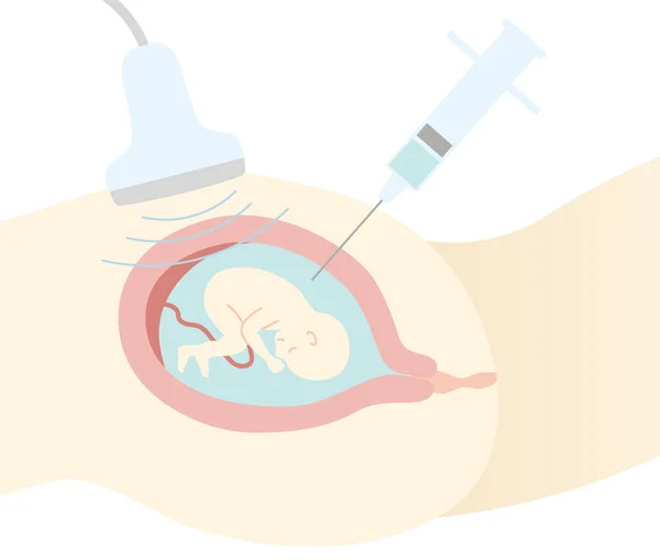 Prenatal Diagnosis Amniocentesis Illustration Pregnant Woman Stomach Seen Side Flat — Stok Vektör