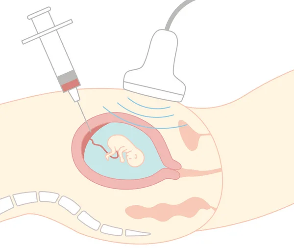 Prenatal Diagnosis Chorionic Villus Test Illustration Pregnant Woman Stomach Seen — Vector de stock