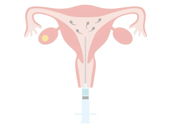 Infertility Treatment Using Artificial Insemination Illustration Pregnancy Childbirth — 스톡 벡터
