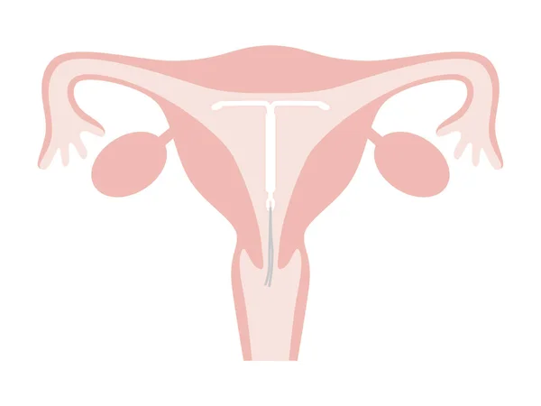 Uterus Intrauterine System Ius Simple Flat Illustration — 스톡 벡터