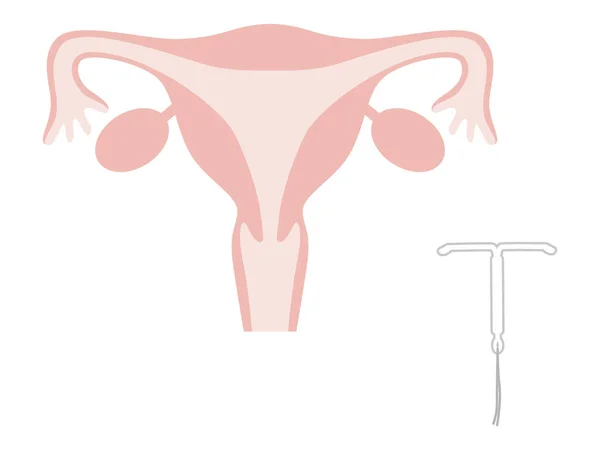 Intrauterine System Ius Pre Wearing Uterus Simple Flat Illustration — 스톡 벡터