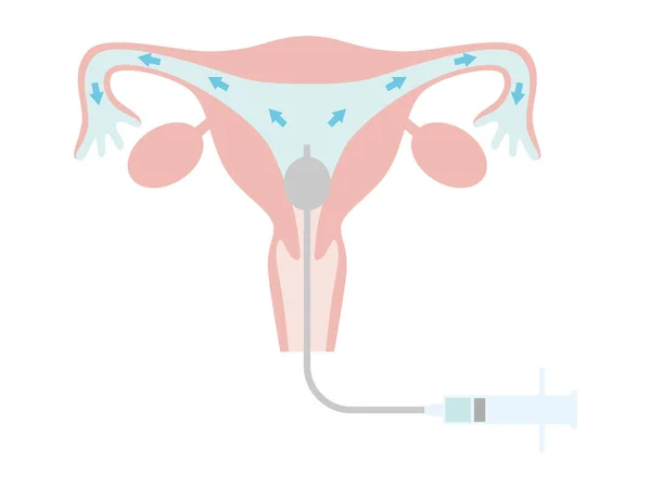 Hysterosalpingography Fertility Treatment State Which Contrast Medium Placed Uterus Illustration — 스톡 벡터