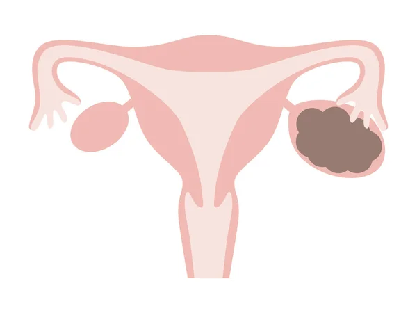 Illustration Ovarian Endometriosis Chocolate Cyst Diseases Uterus Women — Vettoriale Stock