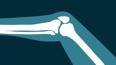 Diz ekleminin siyah arkaplandaki x-ray görüntüsü