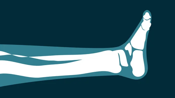 Рентгеновское Изображение Ноги Черном Фоне — стоковое фото