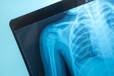 Mavi arka planda bir çocuğun göğüs röntgeni.