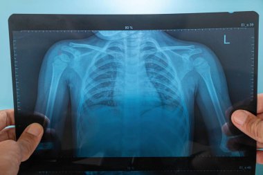 Elinde mavi arka planda bir çocuğun göğüs röntgeni fotoğrafı var.