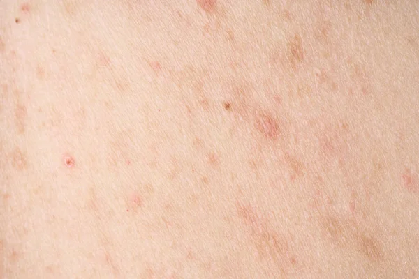 Hud Med Akne Med Röda Prickar Hälsoproblem Hudsjukdomar Närbild Allergi — Stockfoto