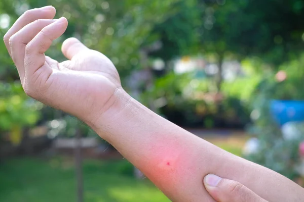Swollen Arms Due Mosquito Bites Poisonous Animals Plague Rainy Season — Stock Photo, Image