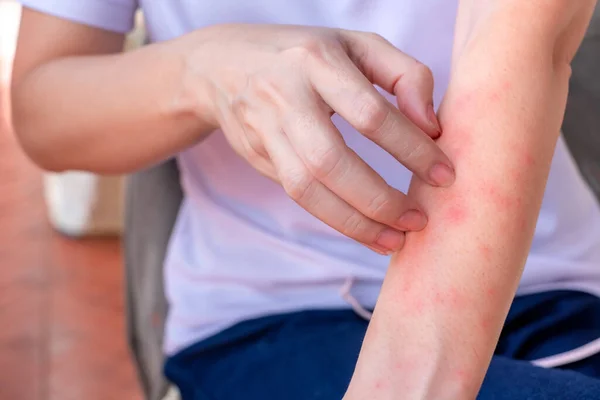 stock image Close up of woman arm scratch the itch by hand at home, itching due to rash, fungus, allergy, dermatological disease, dry skin. Healthcare and medical concept.