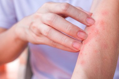 Kadının kolunun kaşıntısını evde elle kaşıma, kaşıntı, kızarıklık, mantar, alerji, dermatolojik hastalık, kuru deri. Sağlık ve Tıp Konsepti.