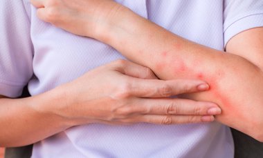 Kadının kolunun kaşıntısını evde elle kaşıma, kaşıntı, kızarıklık, mantar, alerji, dermatolojik hastalık, kuru deri. Sağlık ve Tıp Konsepti.