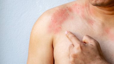 Göğsünde kaşıntı, mantar, alerji, dermatolojik hastalık ve kuru cilt yüzünden kaşınan bir adamın eli. Sağlık ve Tıp Konsepti.
