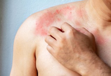 Göğsünde kaşıntılı deri olan ya da kaşındırması gereken bir adamın eli, kaşıntı, mantar, alerji, dermatolojik hastalık, kuru cilt. Sağlık ve Tıp Konsepti.