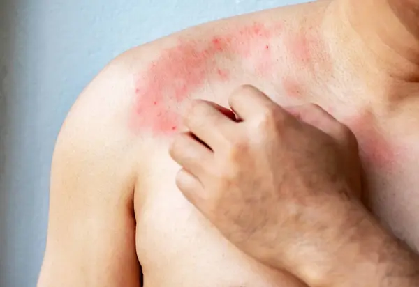 Göğsünde kaşıntılı deri olan ya da kaşındırması gereken bir adamın eli, kaşıntı, mantar, alerji, dermatolojik hastalık, kuru cilt. Sağlık ve Tıp Konsepti.
