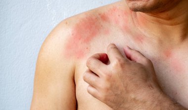 Göğsünde kaşıntılı deri olan ya da kaşındırması gereken bir adamın eli, kaşıntı, mantar, alerji, dermatolojik hastalık, kuru cilt. Sağlık ve Tıp Konsepti.