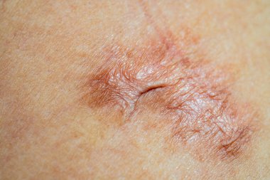 Ameliyat kaynaklı keloid izi, yaralar, deri kusurları ya da kusurlar yüzünden oluşan yaralar. Cerrahi ve tedaviden sonra vücuttaki yara dokusu, dermatoloji ve kozmetoloji kavramı, sağlık bakımı